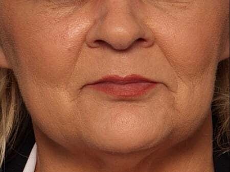 Facial Fillers Before & After