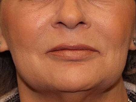 Facial Fillers Before & After