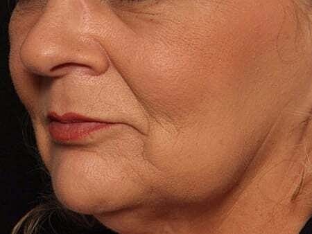 Facial Fillers Before & After