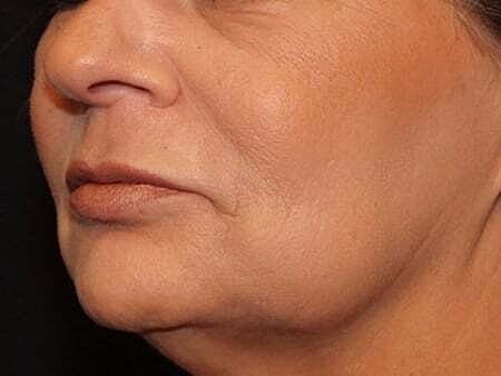 Facial Fillers Before & After