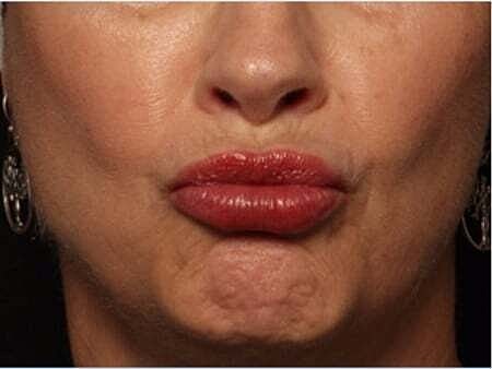 Facial Fillers Before & After