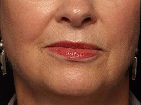 Facial Fillers Before & After