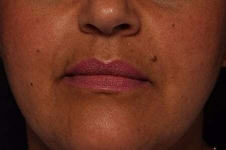 Facial Fillers Before & After
