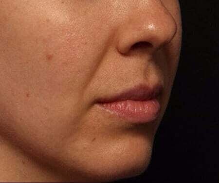 Facial Fillers Before & After