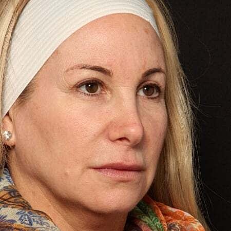 Facial Fillers Before & After