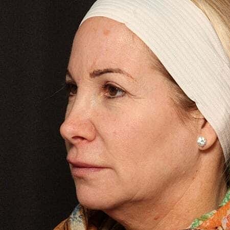 Facial Fillers Before & After