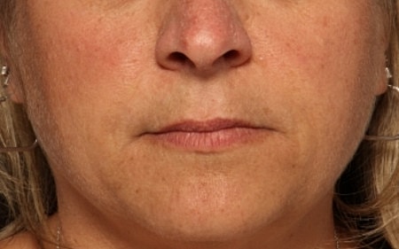 Facial Fillers Before & After
