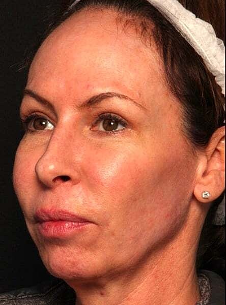 Facial Fillers Before & After