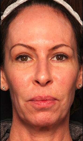 Facial Fillers Before & After