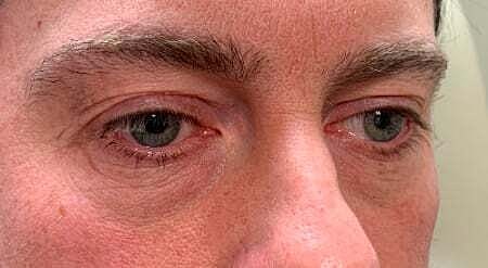 Facial Fillers Before & After