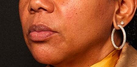 Facial Fillers Before & After