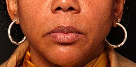 Facial Fillers Before & After
