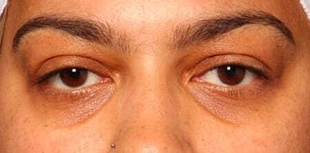 Facial Fillers Before & After