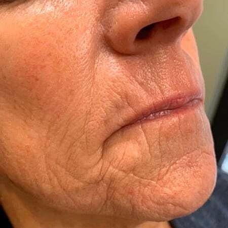 Facial Fillers Before & After