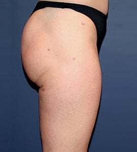 Liposuction Before & After