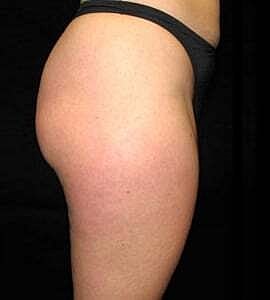 Liposuction Before & After
