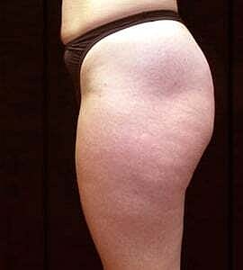 Liposuction Before & After
