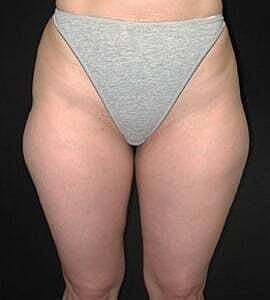 Liposuction Before & After