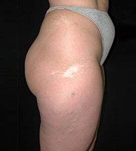 Liposuction Before & After