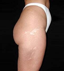 Liposuction Before & After