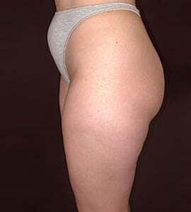 Liposuction Before & After