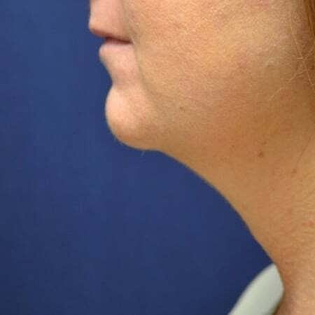 Liposuction Before & After