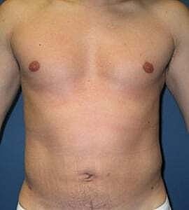Liposuction Before & After