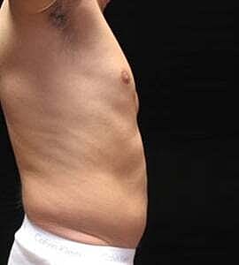 Liposuction Before & After
