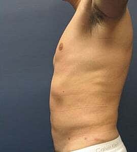Liposuction Before & After