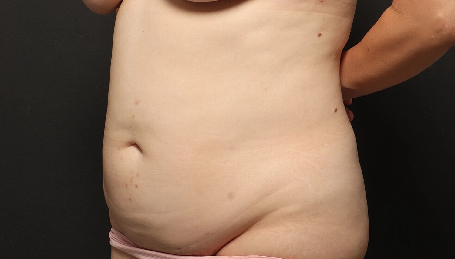 Liposuction Before & After