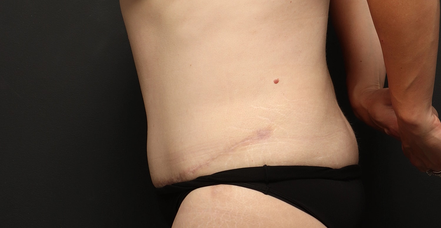 Liposuction Before & After