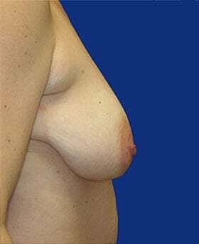 Breast Lift Before & After