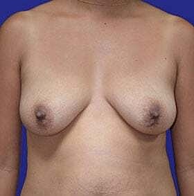 Breast Lift Before & After