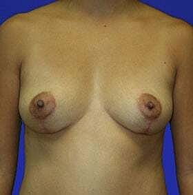 Breast Lift Before & After