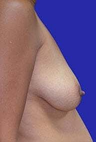 Breast Lift Before & After