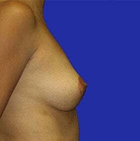 Breast Lift Before & After