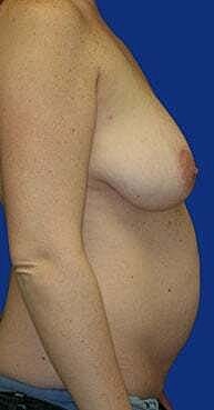 Breast Lift Before & After