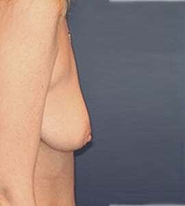 Breast Lift Before & After