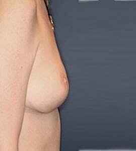 Breast Lift Before & After