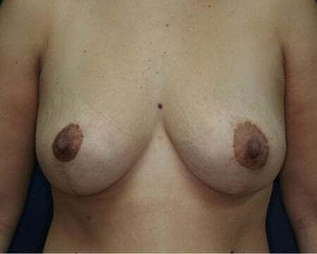 Breast Lift Before & After