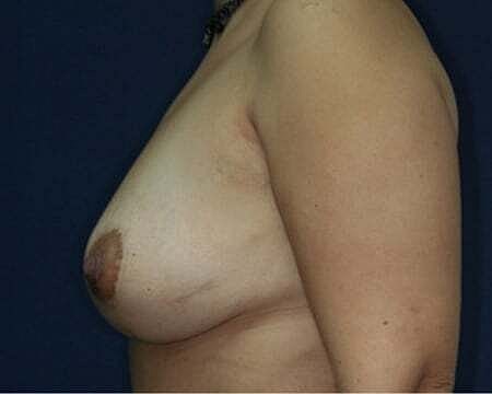 Breast Lift Before & After