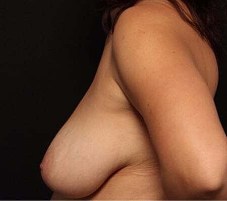 Breast Lift Before & After