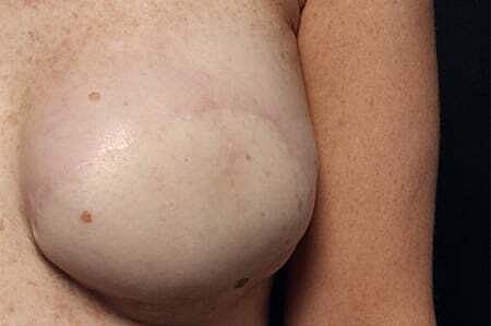 Nipple Tattoo Before & After