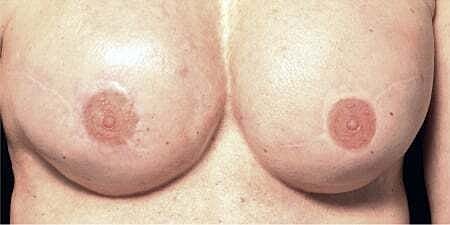Nipple Tattoo Before & After