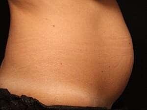 Coolsculpting Before & After