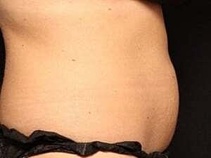 Coolsculpting Before & After