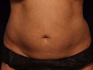 Coolsculpting Before & After