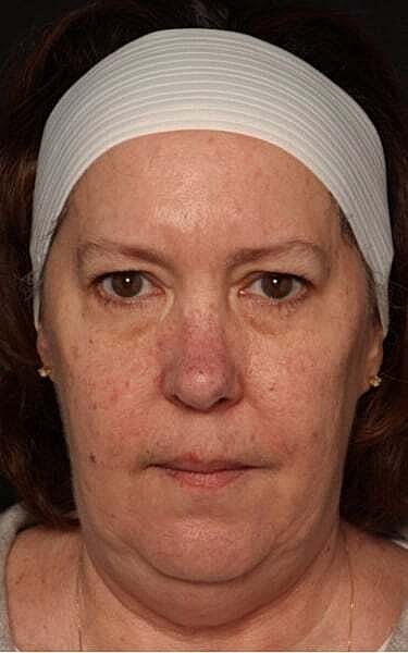 Coolsculpting Before & After