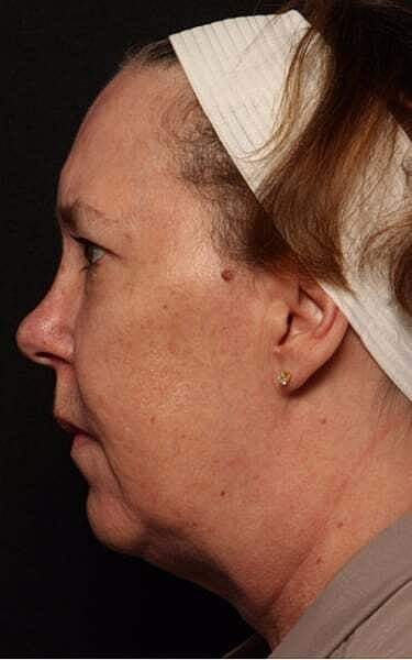Coolsculpting Before & After