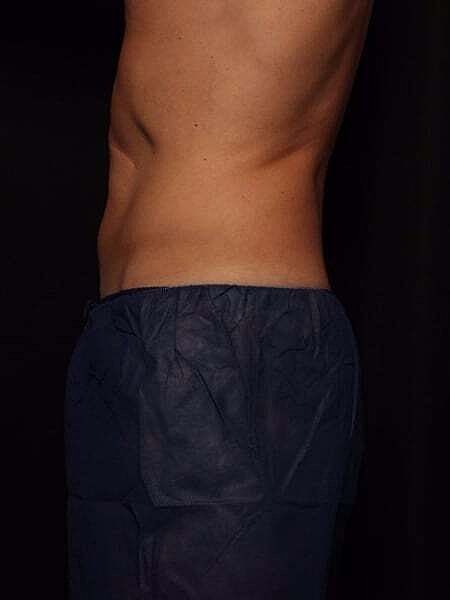 Coolsculpting Before & After